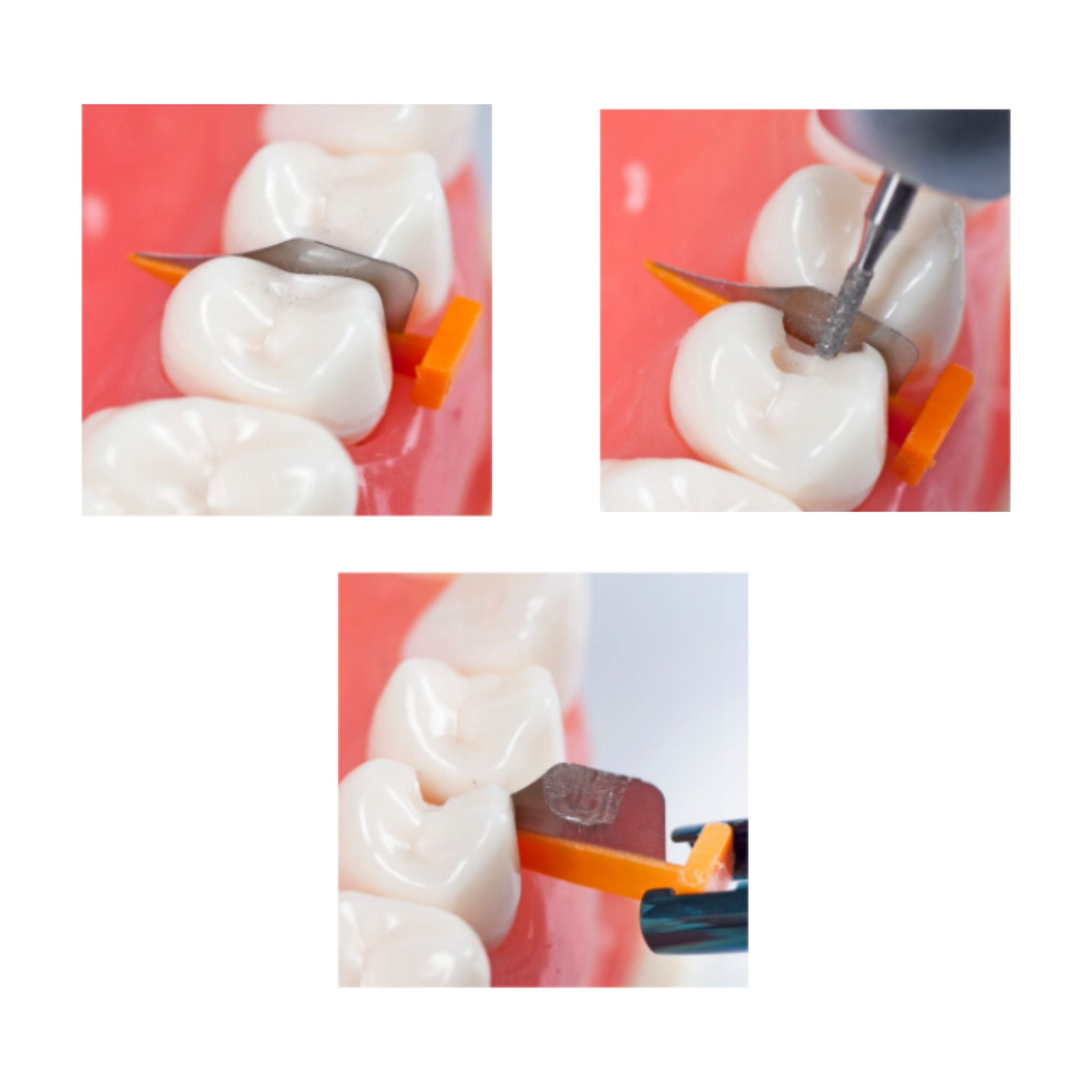 Interdentalkeile <br> FenderWedges