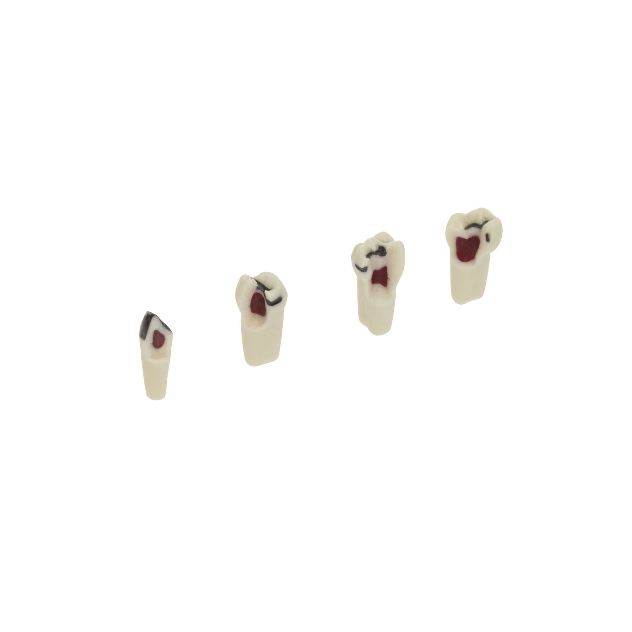 Karies-Milchzähne <br> Mit roter Pulpa <br> AK-6/2 ZPUWPK