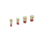 Dreischicht-Zähne mit Karies <br> ZSDPK 300 V1