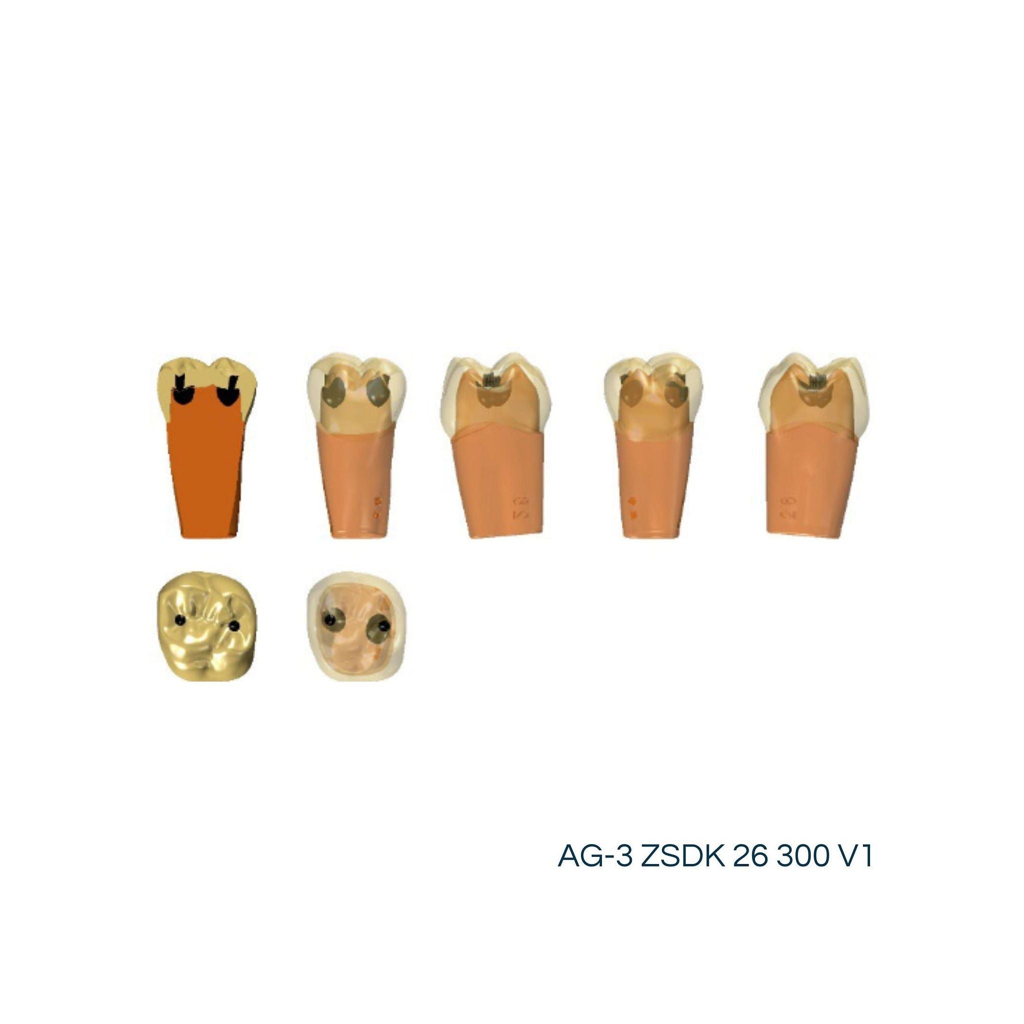Zweischicht-Zähne mit Karies <br> ZSDK 300 V1 | Frasaco