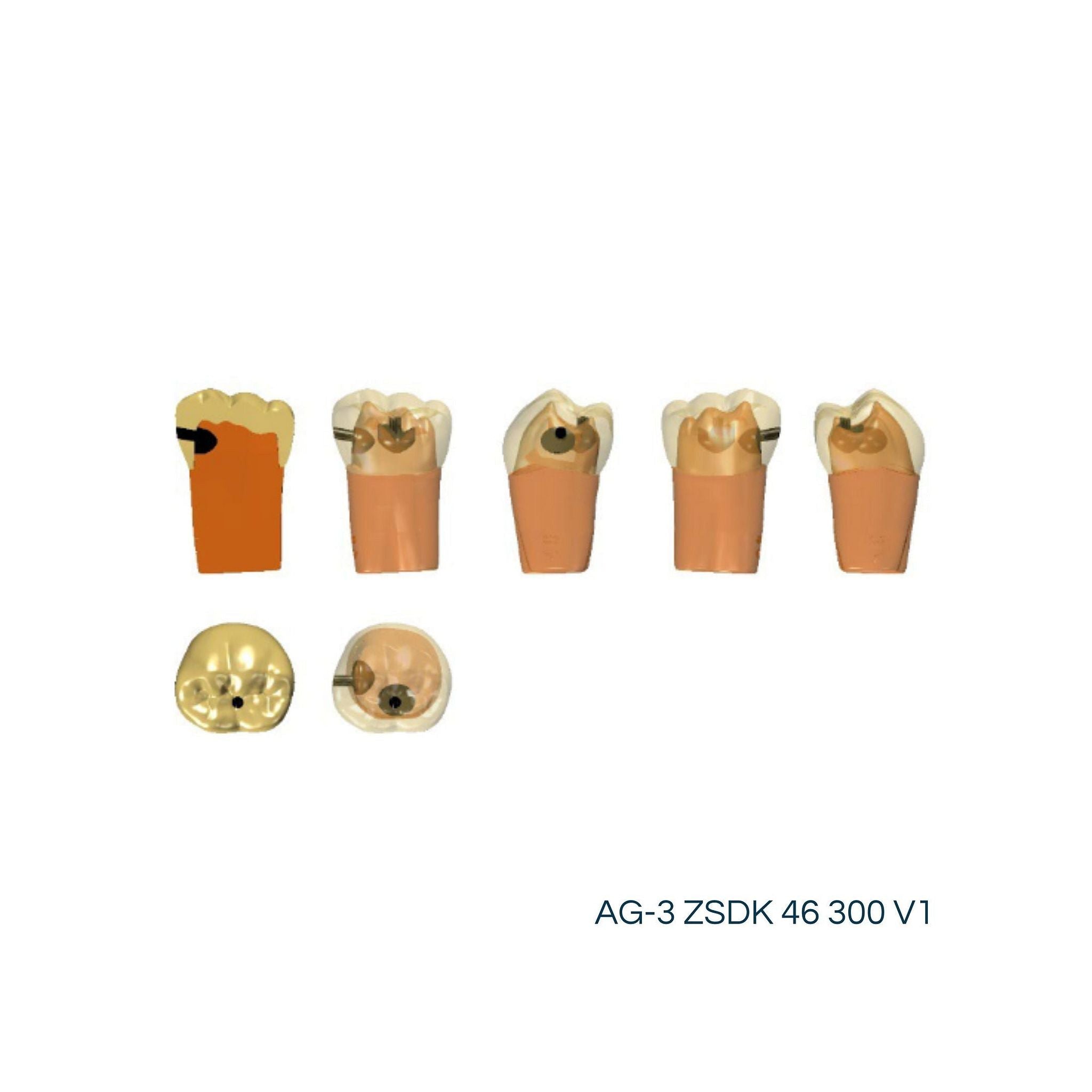 Zweischicht-Zähne mit Karies <br> ZSDK 300 V1 | Frasaco