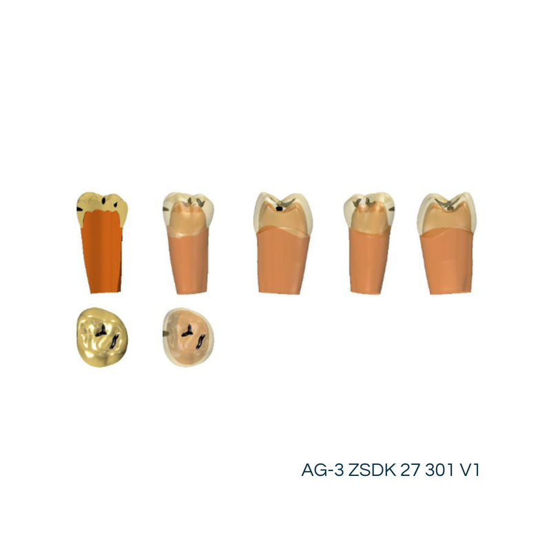 Two-layer teeth with caries<br> ZSDK 301 V1 | Frasaco