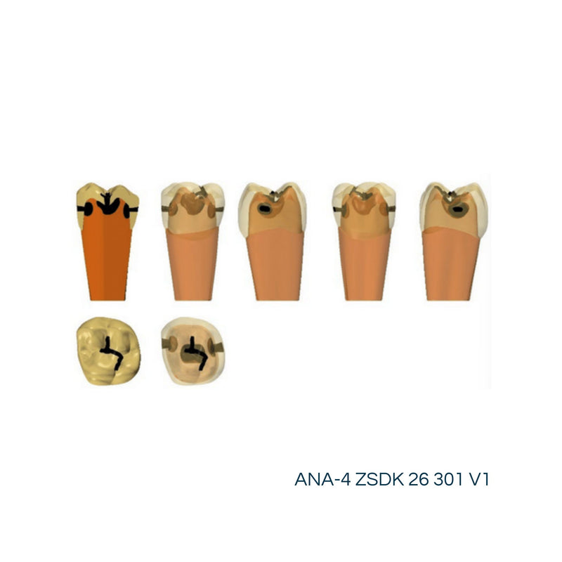 Two-layer teeth with caries<br> ZSDK 301 V1 | Frasaco