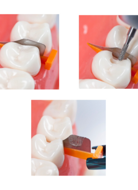 Interdentalkeile <br> FenderWedges